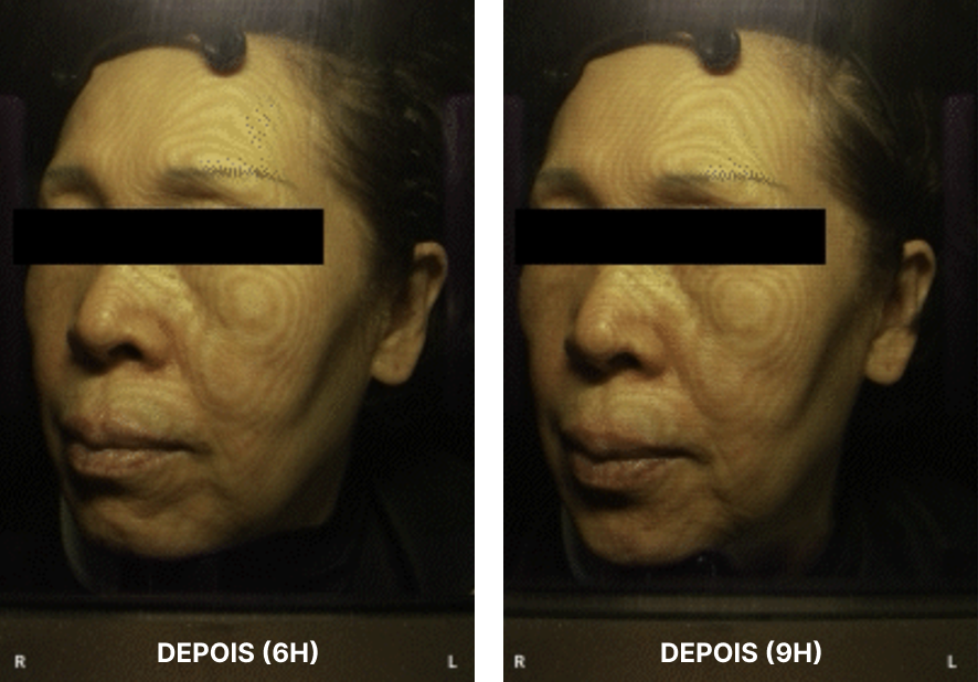 Resultados do tratamento na face